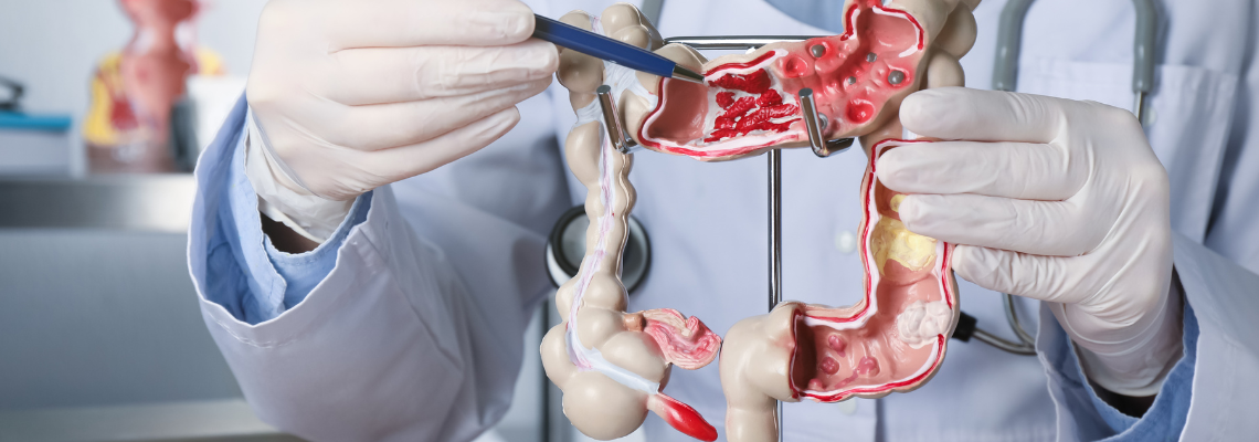 COLON CANCER: WHAT YOU EAT MAY JEOPARDISE YOUR TOMORROW!
