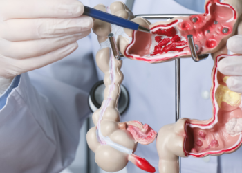 COLON CANCER: WHAT YOU EAT MAY JEOPARDISE YOUR TOMORROW!