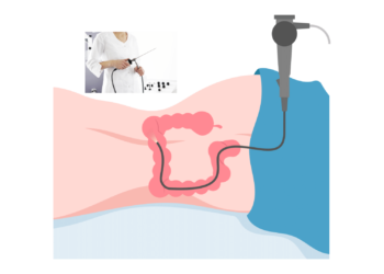 COLONOSCOPY SCREENING? IS IT WORTH THE EFFORT?